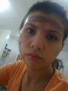 day 2 I applied MEBO ointment