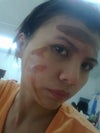 day 2 I applied MEBO ointment