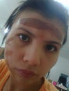 day 2 I applied MEBO ointment