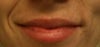 Uneven smile + smile lines, bulge visible on left side