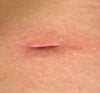 my left side hole