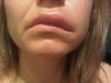 one side swells first 36h after 1 sylinder of 'Juverderm lips' injection