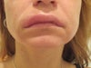 second side swells about 48h after 1sylinder of 'juverderm lips' infection