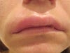 second side/lips swollen 62h after 1sylinder of 'juvederm lips' injection