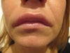 Lips 96h after 1sylinder of 'Juvederm lips' infection