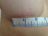 left scar - larger than usual, suture knots scars visible in scarring, hypertrophy.