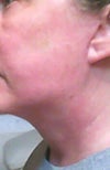 six weeks after surgery