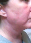 six weeks after surgery