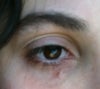 3 weeks post excision of tear trough filler.