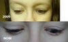 lid lag on downgaze