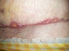 Right infected area.