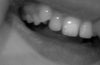 This is one of my pre molar