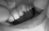 This is my other pre molar