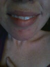 my two front teeth push my lips out when i try to smile