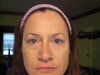 Before lower Blepharoplasty oct 14,2011