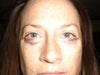 Right after procedure. 10/14/11