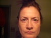Oct 24, 10 days after procedure.  Just starting to notice asymmetry.