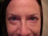 Nov. 18, 5wks post op. Just saw surgeon yesterday. He gave me some shots for bumpiness on outside incisions and puffy spot on left lower lid. some bumpiness has already subsided, but still asymmetric.
