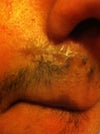 scar right under the nose.