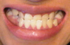 This is how severe my underbite is