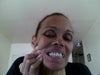 This is the fixed bridge that is infected iam in constant pain every day the infectionis killing me