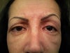 3 weeks after surgery.  Mucus still in left eye.