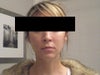 (No expression) One week prior to Ultherapy procedure