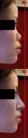 Side profile view, small nose, low radix and barely existent bridge, nostrils are somewhat visible in frontal view.