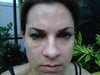 morning of Day 5 after restylane under eyes