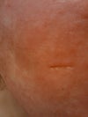 Scar on cheek after total fx treatment