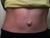 umbilical hernia 11 months after abdominoplasty.  Should I return for repair?  could muscle tear spread to abdominal muscles?