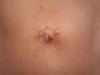 3 weeks post op umbilical hernia repair and scar excision
