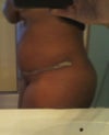 This was before the seroma was drained at 4 weeks post op. Could this have made my skin loose. my stomach isnt as tight as it could be