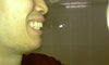 Tooth protrusion w/ slightly flared out teeth