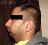 chin augmentation  implants