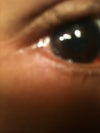 The scrunching in the right eye.