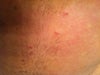 These bumps are like mosquito bites, but with a hard knot under the surface.  They are hard, sore and itchy.  And they have not shrunk at all in 2 weeks time, even after cortisone injections.