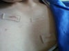 my keloids.