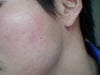 my acne scarring