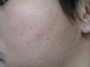 my acne scarring