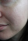 Crepey wrinkles and damaged skin on cheeks