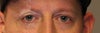 eyelid 1
