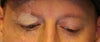 eyelid 2