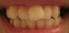 my teeth have shifted a lot and you can see how weird it looks to have one central incisor that is now crowded and almost looks crooked