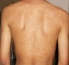 PIH on back