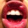 this is the lump on the left side. Only my top lip was injected. The dissolver was injected into both sides of my lip