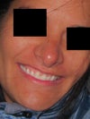 One year after 1st rhinoplasty.