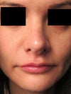 2 months after revision rhinoplasty.