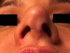 2 months after revision rhinoplasty.