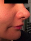 2 months after revision rhinoplasty.